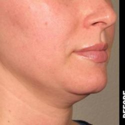 Ultherapy Before & After Patient #1552